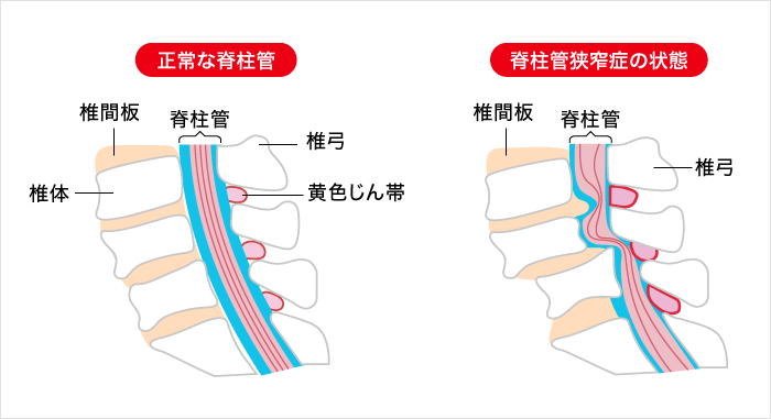 脊柱管狭窄症の図