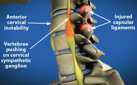 頚椎症の図