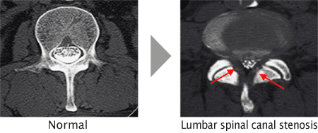 MRI脊柱管狭窄症